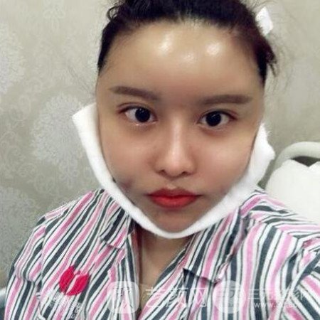 成都銅雀臺雷剛吸脂瘦臉一個月案例分享~